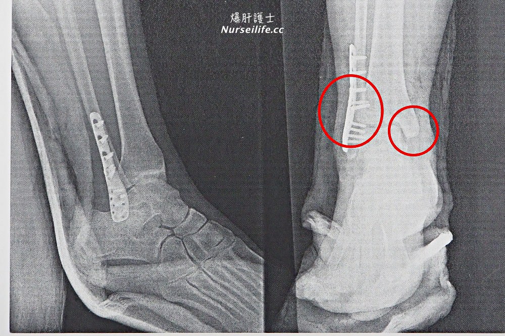 出國旅遊骨折受傷緊急就醫、旅遊保險申請及骨折復原復健護理注意事項 - nurseilife.cc